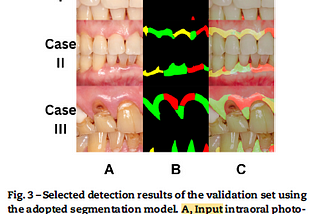 Brief Review — Accuracy of Artificial Intelligence-Based Photographic Detection of Gingivitis