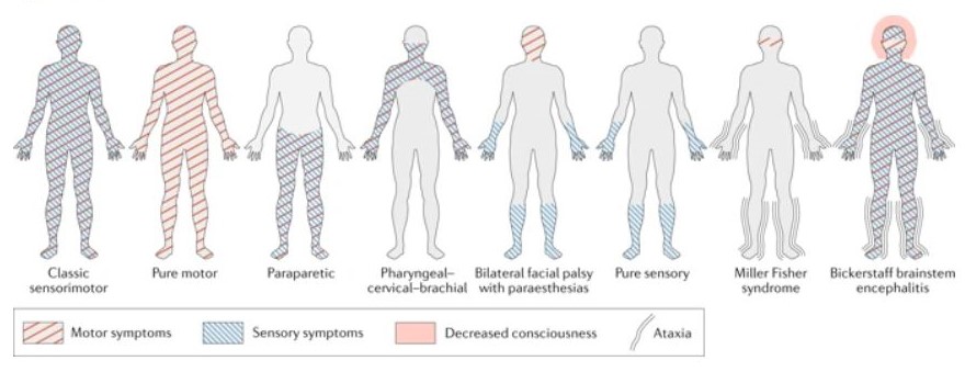 Guillain Barré Syndrome