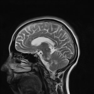 extensive brainstem and cerebellar involvement