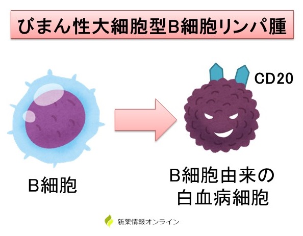 びまん性大細胞型B細胞リンパ腫（DLBCL）とCD20