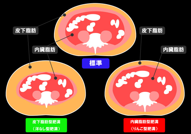 皮下脂肪と内臓脂肪、そして内臓脂肪型肥満と皮下脂肪型肥満のMRI(断面図)