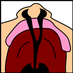 Celah bibir dan lelangit bilateral
