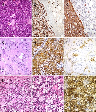 Tumor of the thyroid with solid cell nest features disclosing small cells of the main cell type (a) that express p63 (b) and cytokeratin 5 (c), in the absence of TTF1, calcitonin, and thyroglobulin expression. Hyalinizing trabecular tumor (d–f) is composed of trabeculae of elongated or polygonal cells admixed with abundant amounts of hyaline material negative for amyloid and positive for type IV collagen (f); Ki-67 is characteristically expressed in the cell membrane but not in the nuclei of the tumor cells (e). Follicular adenoma with signet ring cells (g and h), showing strong positivity for thyroglobulin (i)[7]