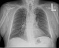 Radiografia posteroanterior de tòrax