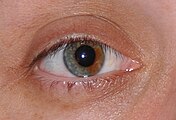 Heterocromia sectorial.