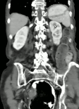 Coronal view of sigmoid volvulus with "whirlpool sign"