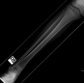 Spiral fracture of the tibia