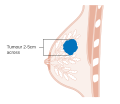 Stage T2 breast cancer