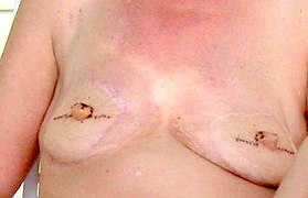 Mature female after breasts removal and reconstuction.jpg