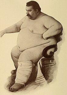 איור מתוך ספר רפואה משנת 1897 המתאר אדם הסובל מהשמנת יתר