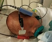 Na imagem aparece um bebê recém-nascido dormindo usando chupeta com eletrodos na testa e nas orelhas, nas orelhas há também duas caixinhas de fones, uma vermelha para a orelha direta e uma azul para a esquerda