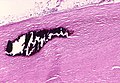 Fibrosis pleura teruk dengan kalsifikasi fokus.