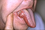 Thumbnail for Oral cancer