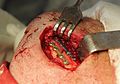 العلاج الجراحي لكسر الزاوية الفكيّة السفليّة.