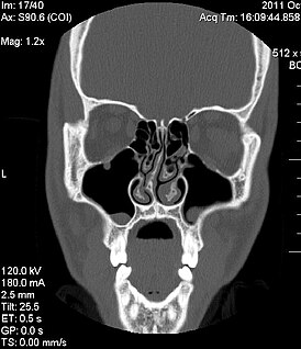 Изображение компьютерной томографии, показывающее отклонение носовой перегородки