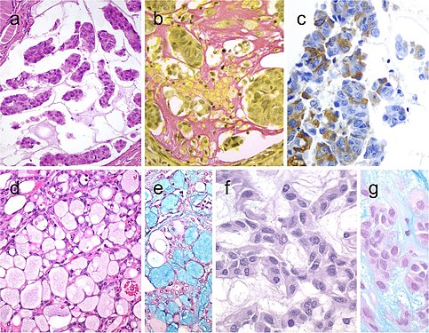 Mucinous thyroid carcinoma (a) showing abundant mucoid material mucicarmine positive (b); most tumor cells were positive for thyroglobulin (c). In this mucinous variant of follicular thyroid carcinoma (d), the follicles were distended and full of Alcian blue–positive mucinous material (e). Mucinous variant of papillary thyroid carcinoma (PTC) (f), the tumor showed ribbon, trabecular and/or follicular pattern, classic nuclear features of PTC and abundant mucoid stroma positively stained with Alcian blue (g)[7]