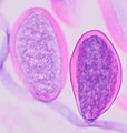 Later E. vermicularis eggs, of the same size as early eggs but having undergone more mitoses. H&E stain