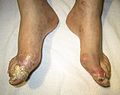 Gout complicated by ruptured tophi (exudate tested positive for uric acid crystals)