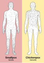 In contrast to the rash in smallpox, the rash in chickenpox occurs mostly on the torso, spreading less to the limbs.