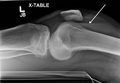 A lipohemarthrosis due to a subtle tibial plateau fracture
