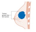 Stage T3 breast cancer