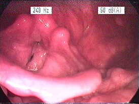 Эндоскопическое изображение гортани при ларингите, вызванном кислотным рефлюксом