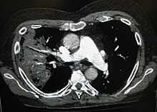O imagine tomografică alb-negru a organelor interne în secţiune longitudinală. Acolo unde ar trebui să fie negru în partea stângă, se vede o zonă albă întretăiată de dungi negre.