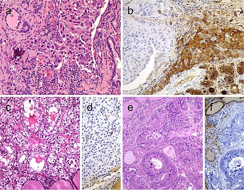 Metastatic carcinomas in the thyroid gland. Thyroid metastasis from lung adenocarcinoma (a, b). Some metastatic tumor cells (right) are positive for thyroglobulin due to diffusion artifact and should not be overinterpreted as positive (b). Metastatic clear cell renal carcinoma (c), metastatic renal cells are negative for thyroglobulin (d). Colonic adenocarcinoma metastatic to the thyroid gland (e); the thyroid tissue is positive for thyroglobulin while the metastatic adenocarcinoma is negative (f)[7]