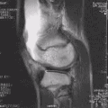 Ressonância magnética (RM) de um joelho.