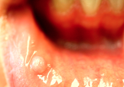 Photo of irritation fibroma on the labial mucosa.