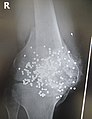 Zdjęcie stawu kolanowego – widoczne liczne kulki śrutu po postrzale ze strzelby