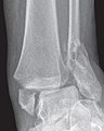 bimalleolar fracture