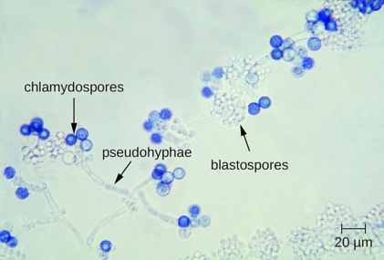 Pseudohyphae, chlamydospores and blastospores of Candida yeast.