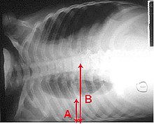 Radiografie pulmonară cu pacient în poziţie orizontală. Zona neagră din partea de jos, care reprezintă plămânul drept, este mai mică și prezintă dedesubt o parte mai albă, revărsatul pulmonar. Săgeţile indică dimensiunile acestora.