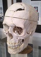 Gage's disassembled skull on display at the Warren Anatomical Museum (Harvard Medical School)