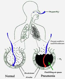 O diagramă schematică a plămânilor umani, cu un cerc gol în partea stângă, reprezentând o alveolă normală, și cu unul în partea dreaptă, ilustrând o alveolă plină cu fluid, ca în pneumonie