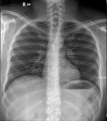 X-quang hoặc phổi người