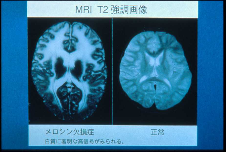 先天性筋ジストロフィー