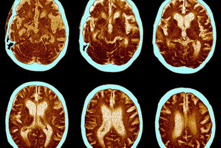 MRI images of the brain