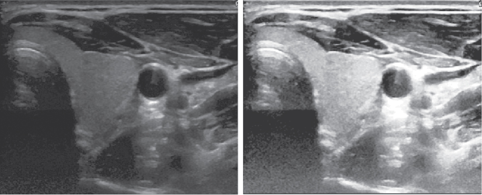 Figure 1 Left: Thyroid image before pre-processing, Right: Thyroid image after pre-processing.