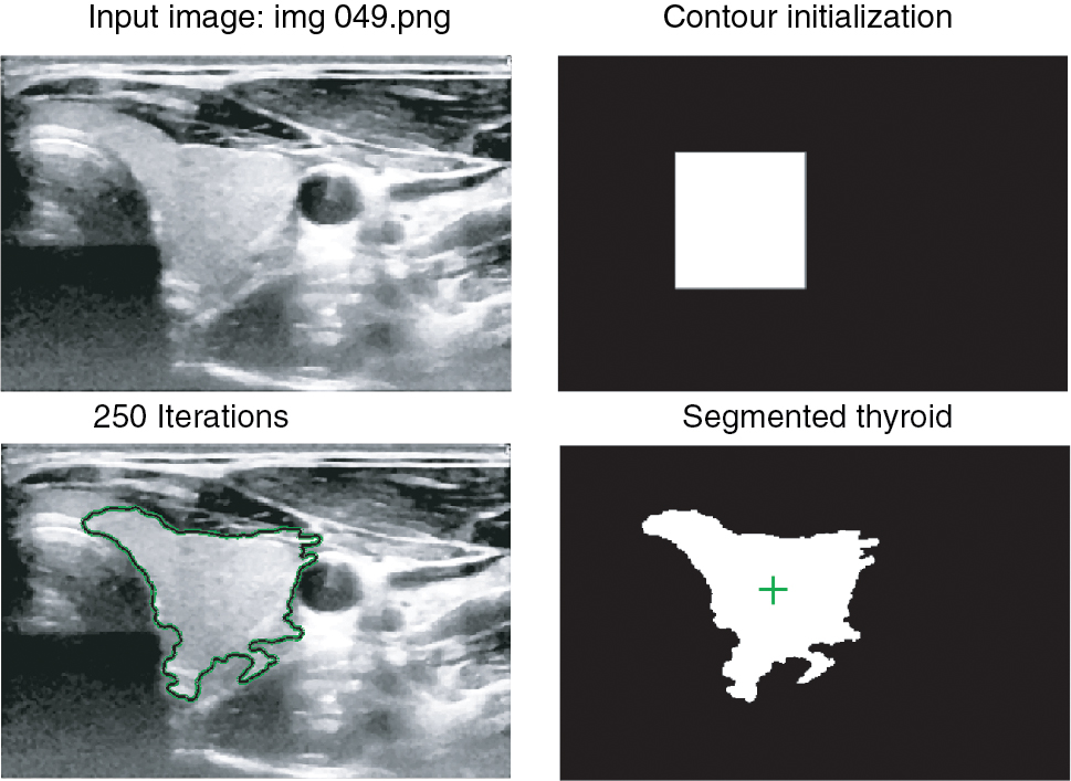 Figure 3 Top Left: Pre-processed thyroid, Top Right: Freehand drawn initial mask, Bottom Left: Segmented region shown by green contour obtained after 250 iterations, Bottom Right: Binary image showing segmented region in white with its center of mass shown by a green mark.