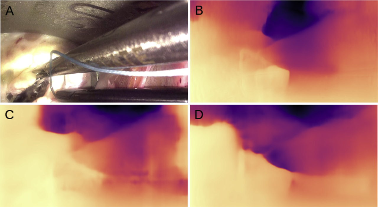 Figure 2: Depth prediction results on the stereo-endoscopic images from reconstructive mitral valve surgery. The network is trained on the KITTI dataset [5]. A min-max normalisation is performed on the depth map for visual representation and a reverse magma colormap is applied. Lighter areas represent regions closer to the camera and darker regions represent distant regions. B, C and D represent mono, stereo and mixed models respectively.