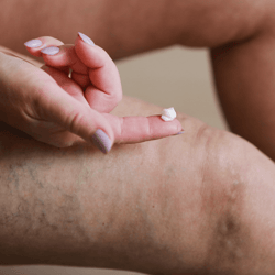 vein smoothing varicose veins cream