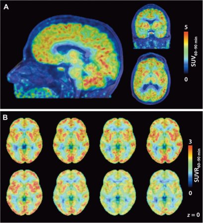 A New Type Of Brain Scan Shows Where Genes Are Being Turned Off