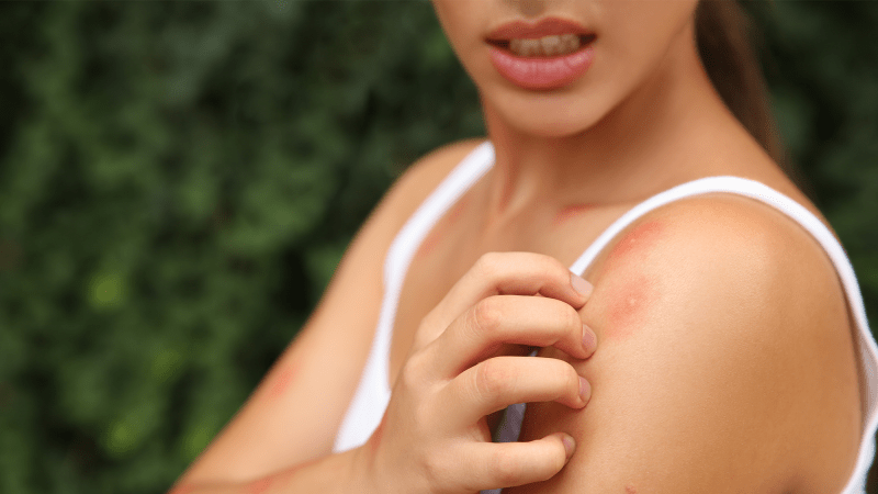 a woman scratches several red mosquito bites on her shoulder