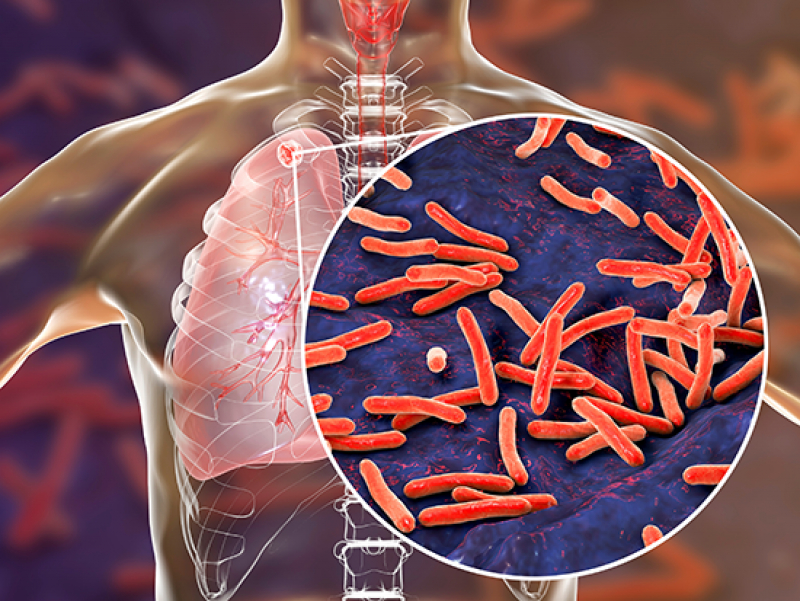 NIH grant establishes UAB&rsquo;s Global Research Resource for Human Tuberculosis